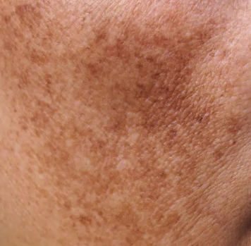 Melasma