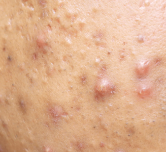 Nodules