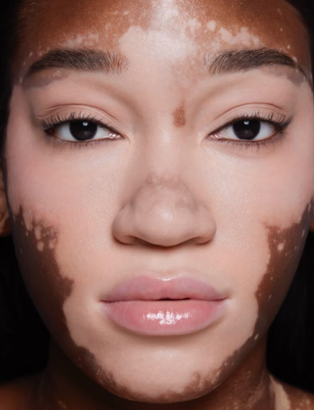 Vitiligo Skincare collection with toner, serum, face cream