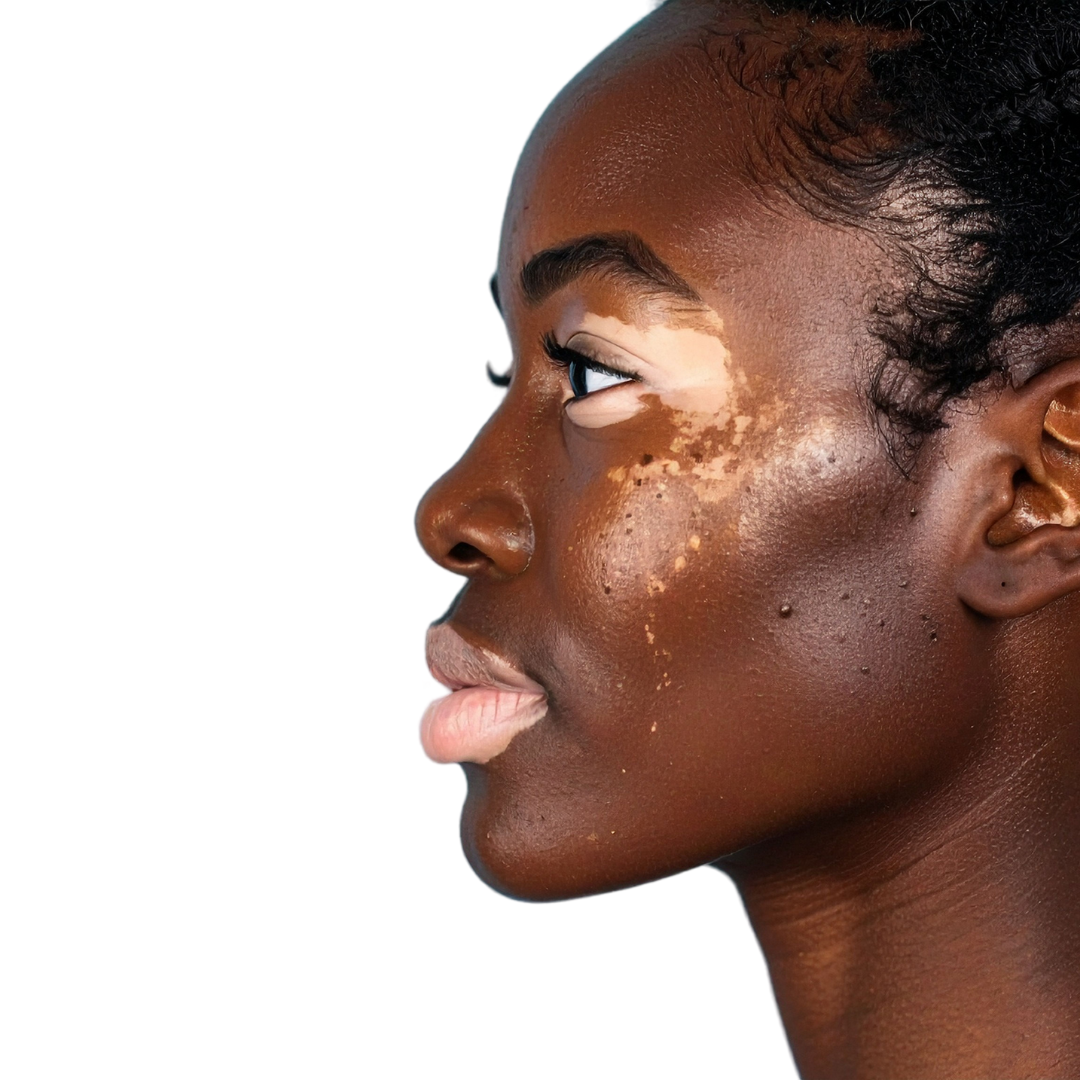 Vitiligo Skincare Collection