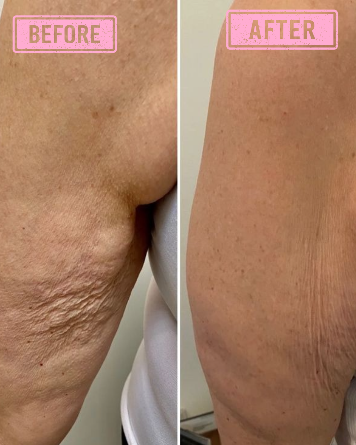 Shuntia Symonette Body Sculpt Cream for cellulite and stretch marks in a glossy pink floral jar with roses, pearls, and firming skincare